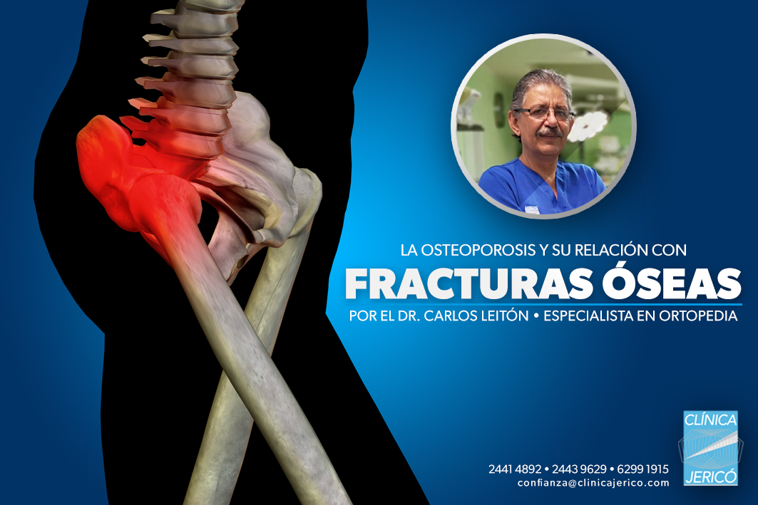 La Osteoporosis y su relación con fracturas óseas